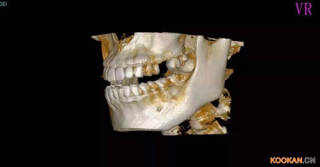 采購口腔CBCT，多大的視野比較好